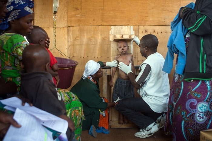 A severely malnourished child stands as MSF staff measure his height at an MSF-supported health centre in Bukama, Masisi, Democratic Republic of Congo.