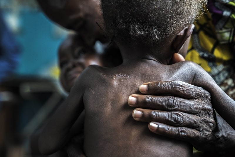 Malnourished 17-month-old twins brought to the Ditekemena health centre by their grandparents. They have been hiding in the bush for five months after armed militias attacked their village. Both of their parents were killed and the babies suffered knife wounds.
